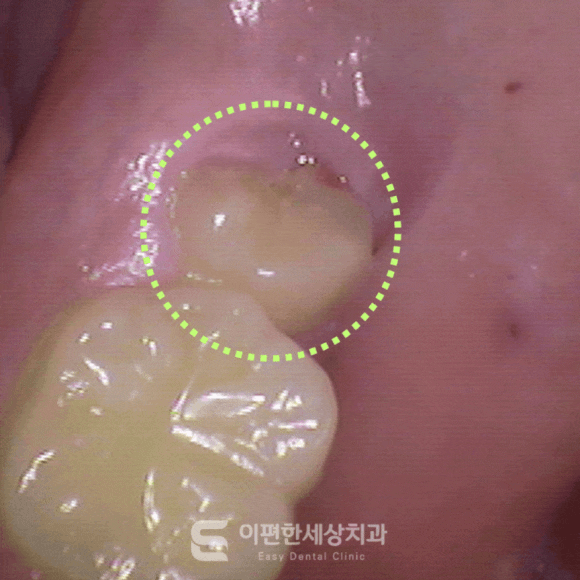 강서매복사랑니 한 번에 4개 발치 가능할까? 관련 이미지 4