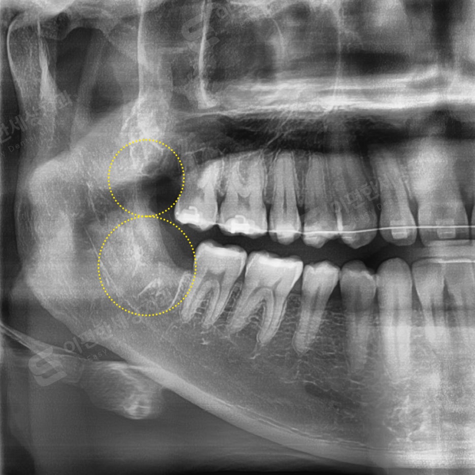 사랑니 발치 치과, 찾는 분들 읽어보세요. 관련 이미지 15