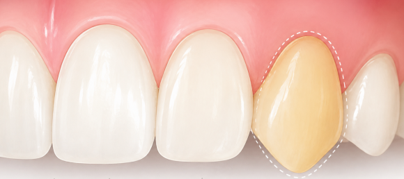 Can Yellowish Canines Be Improved with Teeth Whitening? image 4