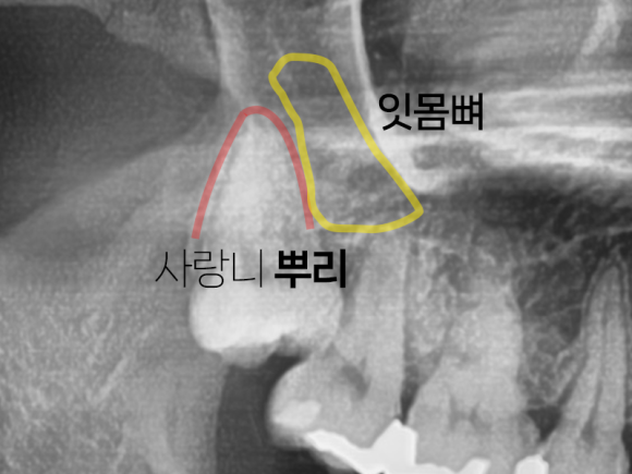 화곡사랑니, 빨리 뽑아야 이득인 이유 관련 이미지 2