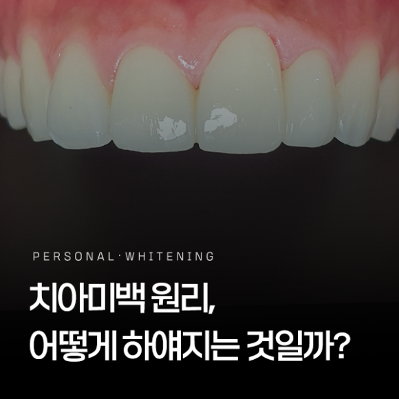 화곡역치아미백 원리는 무엇일까요? 스케일링, 치면세마와 다른 점은? 관련 이미지 1