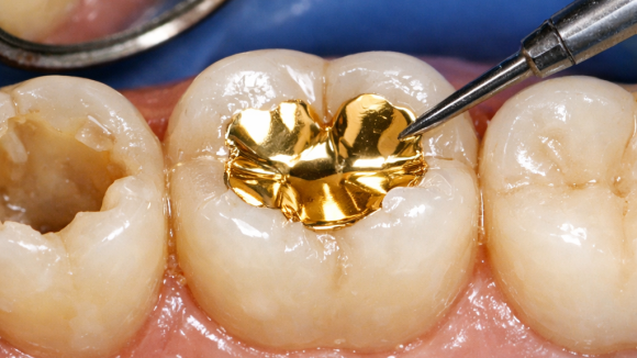 레진 인레이 차이 어떤 기준으로 선택해야 할까요? 관련 이미지 4