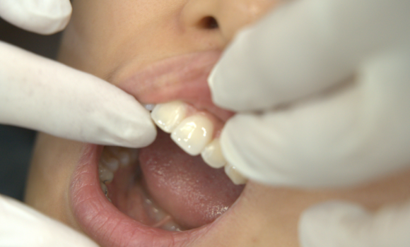 강서구 라미네이트 치과, 시술 전 후회하지 않으려면 꼭 확인하세요 관련 이미지 10