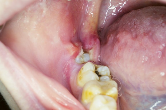 강서구사랑니발치 꼭 해야 할 지 고민이라면 5분만 투자해서 읽어보세요 관련 이미지 1