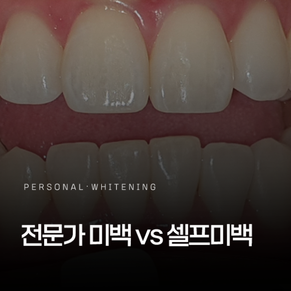 화곡동치과, 전문가 미백과 셀프 미백의 차이점은? 치과에서 해야 하는 이유 관련 이미지 1