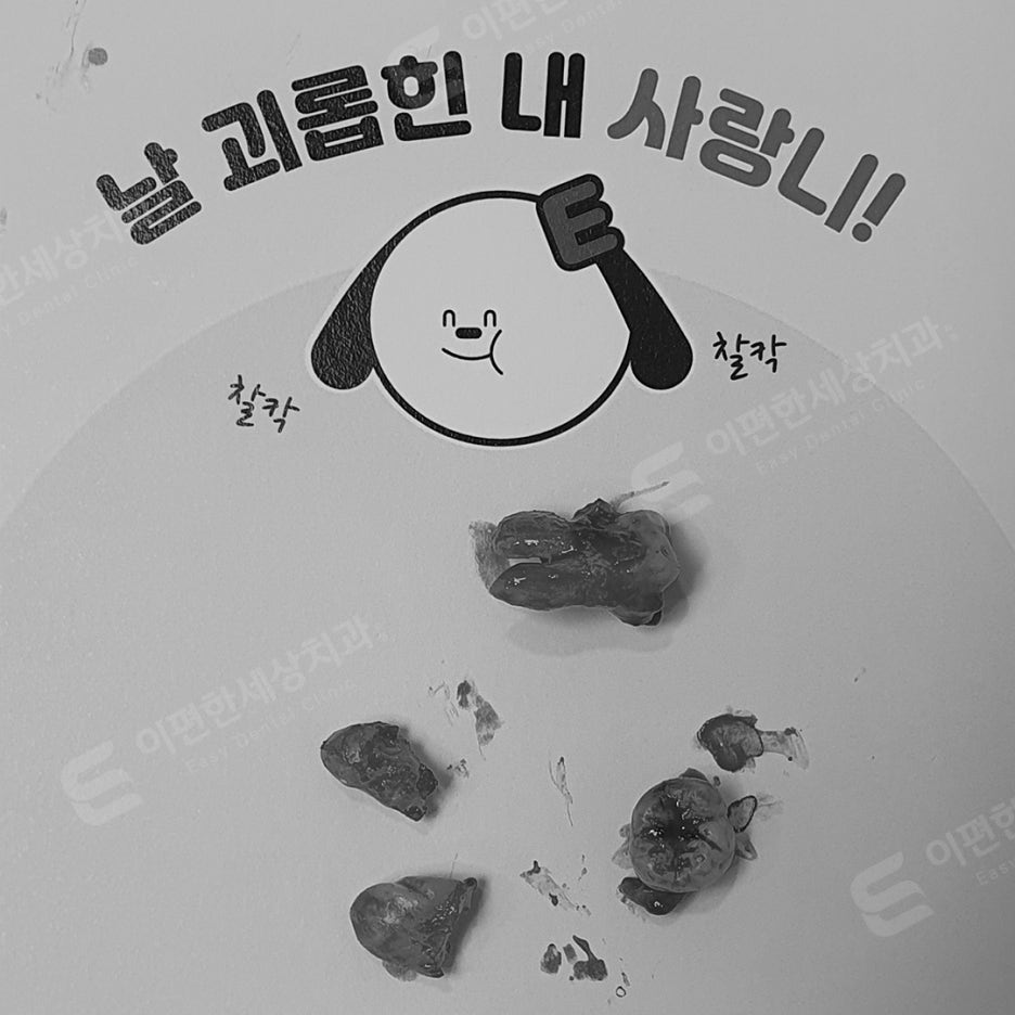 사랑니 발치 치과, 찾는 분들 읽어보세요. 관련 이미지 11
