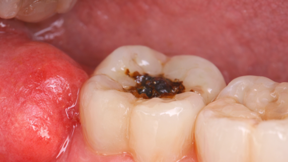 사랑니 잇몸 부음 참으면 절대 안 되는 이유 관련 이미지 2