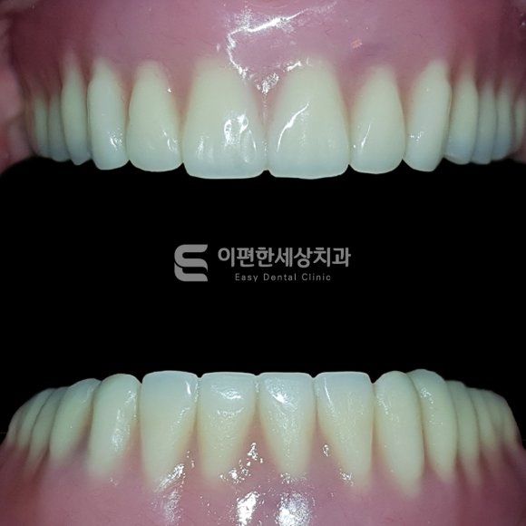 화곡동임플란트 틀니(오버덴쳐) 어떤 상황에서 필요할까요? 관련 이미지 8