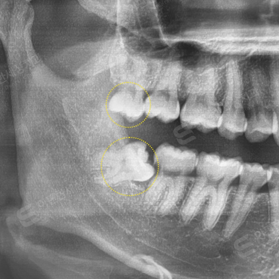 사랑니 발치 치과, 찾는 분들 읽어보세요. 관련 이미지 7