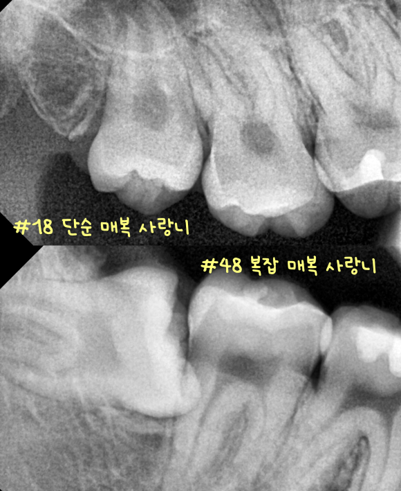 마곡나루역사랑니 발치하려면 꼭 규모가 큰 병원에 가야 할까요? 관련 이미지 2