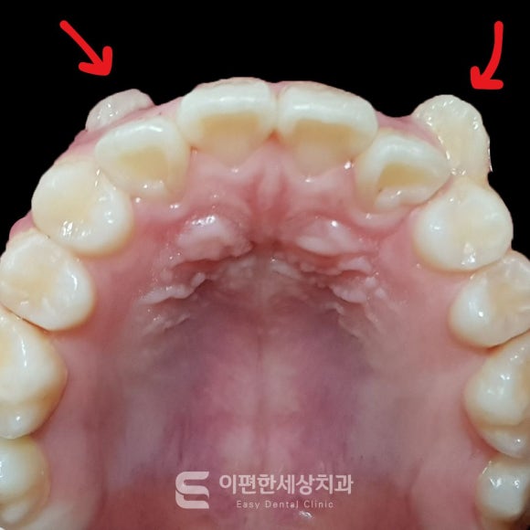 Kkachisan Station Orthodontic Clinic: A Severe Crowded Canine Case—Is Orthodontic Treatment Really Necessary? image 2