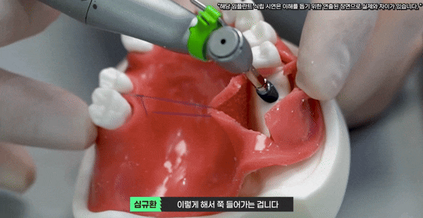 강서구임플란트, 치과 선택? 고민된다면 읽어보세요. 관련 이미지 3