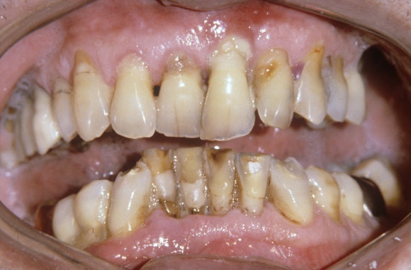 화곡본동치과 2025년 끝나기 전 스케일링 꼭 받아야 하는 이유 관련 이미지 3