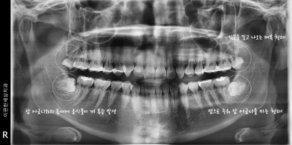 마곡동사랑니 사랑니 발치 통증 마취하면 아예 아프지 않은 걸까? 관련 이미지 8