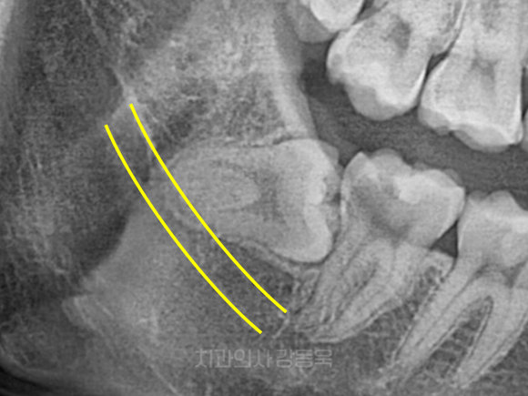 가양동사랑니 처음 뽑는다면? 유형별로 쉽게 이해해 보기 관련 이미지 4