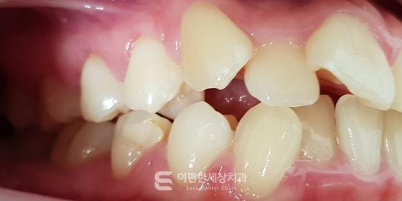 화곡역교정치과 덧니 교정 구강 위생 관리에 큰 영향을 미칩니다. 관련 이미지 2