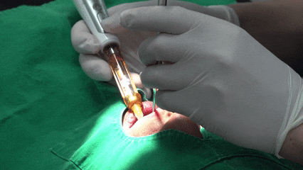 강서구사랑니발치 꼭 해야 할 지 고민이라면 5분만 투자해서 읽어보세요 관련 이미지 3