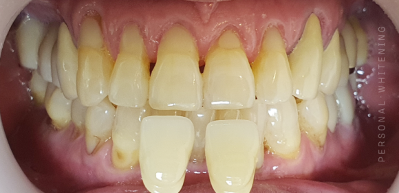 Seoul Teeth Whitening Dental Clinic: In These Cases, You May Be More Likely to See Results! (Candidates for Whitening) image 4
