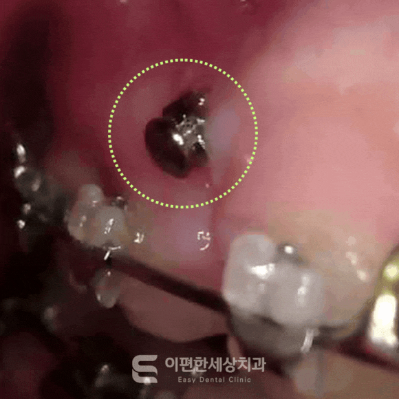 교정할 때 잇몸에 나사를 심는다고? 교정용 스크류가 무엇인지 아시나요? 관련 이미지 1