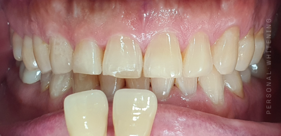 Magok One-Day Tooth Whitening: Is It Possible in Just One Day? image 6