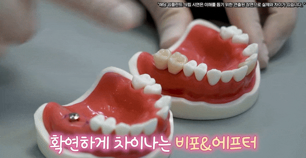 강서구임플란트, 치과 선택? 고민된다면 읽어보세요. 관련 이미지 4