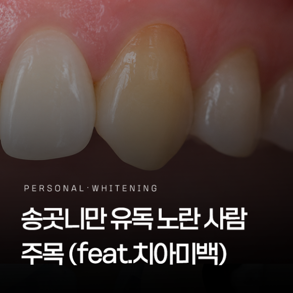 Can Yellowish Canines Be Improved with Teeth Whitening? image 1