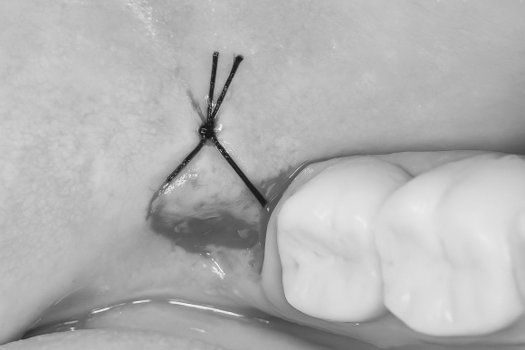 화곡동매복 사랑니 실밥, 중요한 이유는? 관련 이미지 1