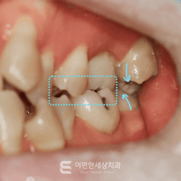 어금니 가위교합 왜 발생하는 걸까요? 치료해야 하는 이유는? 관련 이미지 1