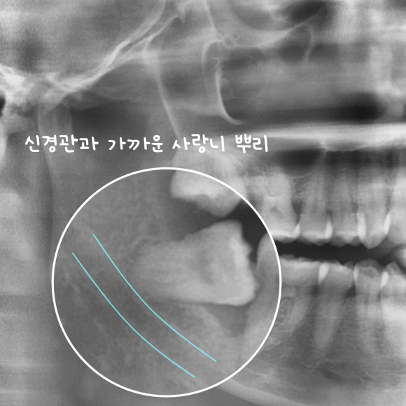 화곡역사랑니 신경 손상 가능성 있어도 대학병원 안 가도 되는 진짜 이유 관련 이미지 6