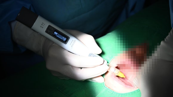 가양역치과 통증이 두려우신가요? 덜 아픈 치료를 위해 저희가 노력하는 것들 관련 이미지 3