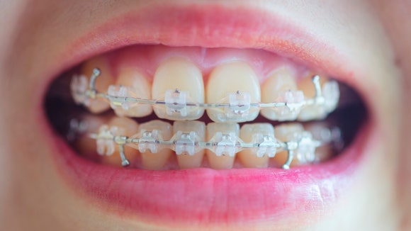 Hwagok Bon-dong Teeth Alignment: My Upper Teeth Cover My Lower Teeth! Can Orthodontic Treatment Improve an Overbite? image 4
