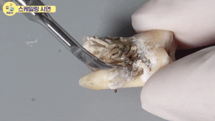화곡본동치과 2025년 끝나기 전 스케일링 꼭 받아야 하는 이유 관련 이미지 2