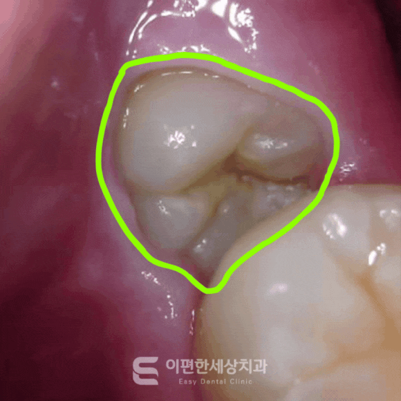 화곡역 사랑니 발치 치과 꼭 대학병원이 아니라도 가능합니다 관련 이미지 2