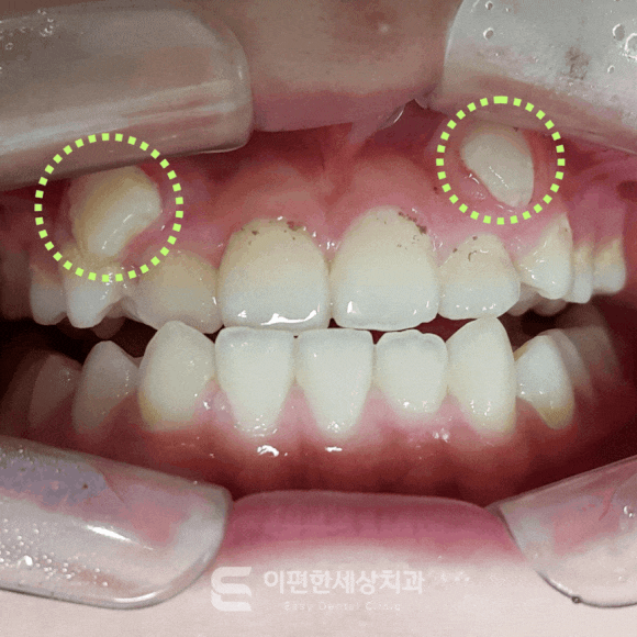 Kkachisan Station Orthodontic Clinic: A Severe Crowded Canine Case—Is Orthodontic Treatment Really Necessary? image 1