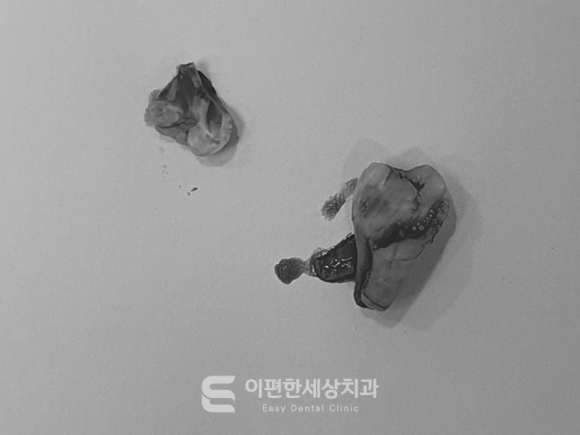 사랑니 엑스레이 CT, 촬영하는 이유는?(강서구화곡동사랑니) 관련 이미지 5