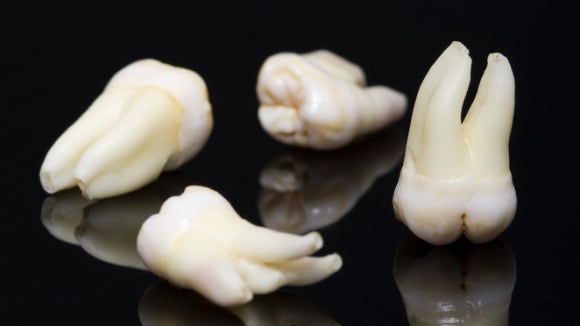 사랑니 엑스레이 CT, 촬영하는 이유는?(강서구화곡동사랑니) 관련 이미지 1