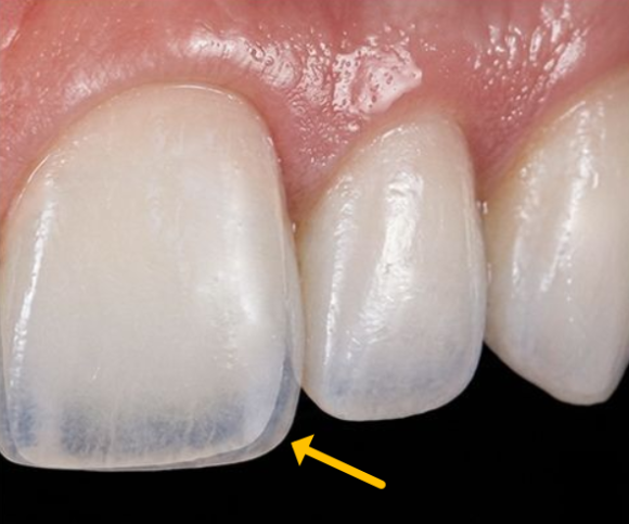 What to Consider When Choosing a Laminate Dentistry Clinic in Hwagok, Seoul image 6