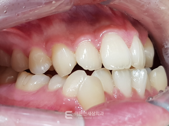 골격성 3급 (주걱턱) 치아교정으로도 개선이 가능할까요? 관련 이미지 4