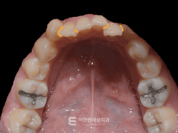 화곡동교정치과 심한 앞니 돌출, 교정이 필요한 이유는? 관련 이미지 4