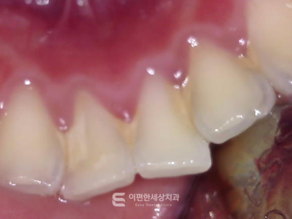 강서구 화곡동 교정치과 치석 관리가 어려운 이유? 삐뚠 치아 때문일 수 있습니다. 관련 이미지 3