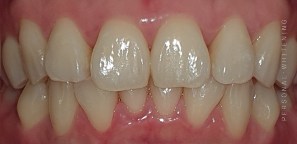 Dental Clinic for Teeth Whitening in Gangseo-gu, Seoul: Why Consider Your Tooth Color but Not Your Skin Tone? image 5