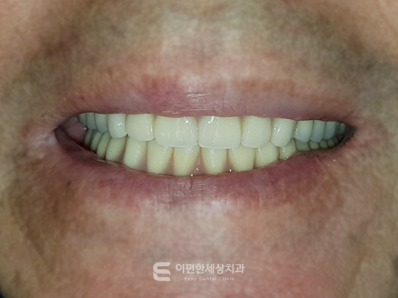 화곡동임플란트 틀니(오버덴쳐) 어떤 상황에서 필요할까요? 관련 이미지 7