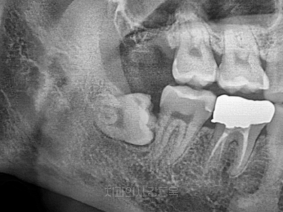 가양동사랑니 처음 뽑는다면? 유형별로 쉽게 이해해 보기 관련 이미지 2