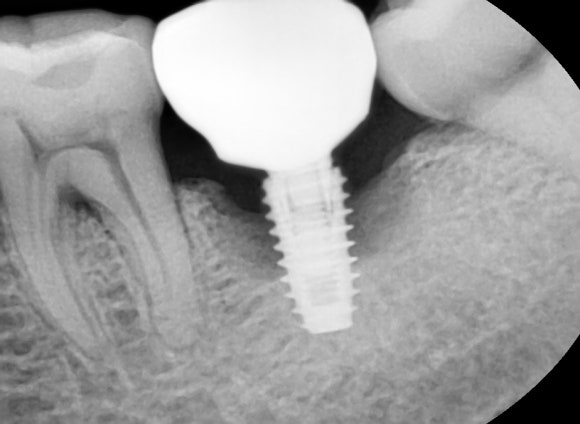화곡동치과추천 임플란트 상담 전 이 3가지를 꼭 기억하세요 관련 이미지 5
