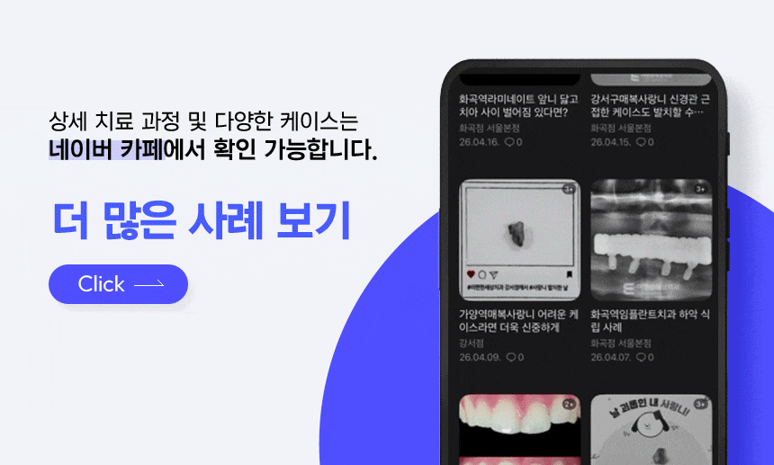 화곡역치아미백 원리는 무엇일까요? 스케일링, 치면세마와 다른 점은? 관련 이미지 8