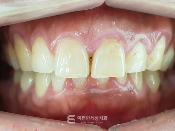 Hwagok Bon-dong Teeth Alignment: My Upper Teeth Cover My Lower Teeth! Can Orthodontic Treatment Improve an Overbite? image 2