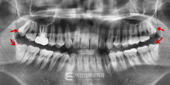강서매복사랑니 한 번에 4개 발치 가능할까? 관련 이미지 2