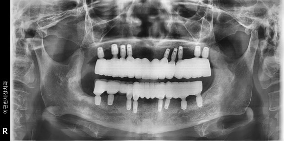 화곡동치과추천 임플란트 상담 전 이 3가지를 꼭 기억하세요 관련 이미지 4