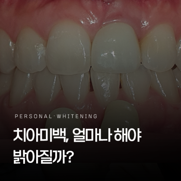 Seoul One-Day Teeth Whitening: How Many Sessions Does It Take to Brighten Your Smile? image 1