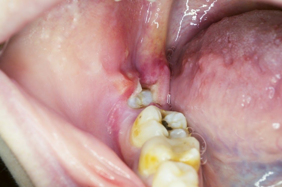 서울사랑니치과 부작용 걱정 없이 발치하고 싶다면 필독 관련 이미지 6